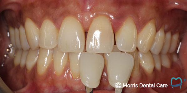 Professional whitening treatment to blend a darkening, damaged tooth for a brighter, lighter smile.